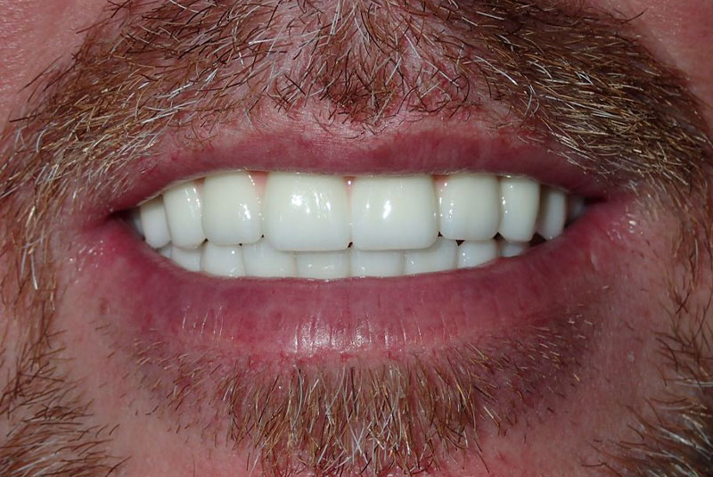 Close up of before and after dental procedure