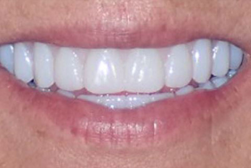 Close up of before and after dental procedure