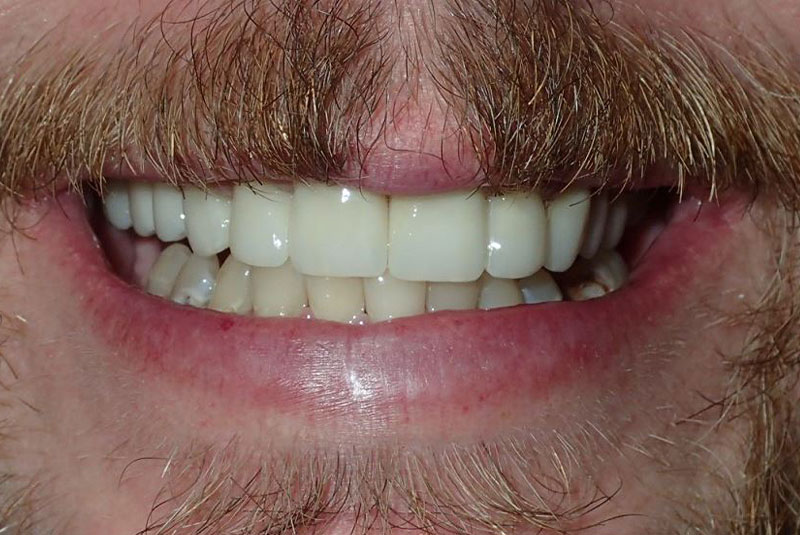 Close up of before and after dental procedure