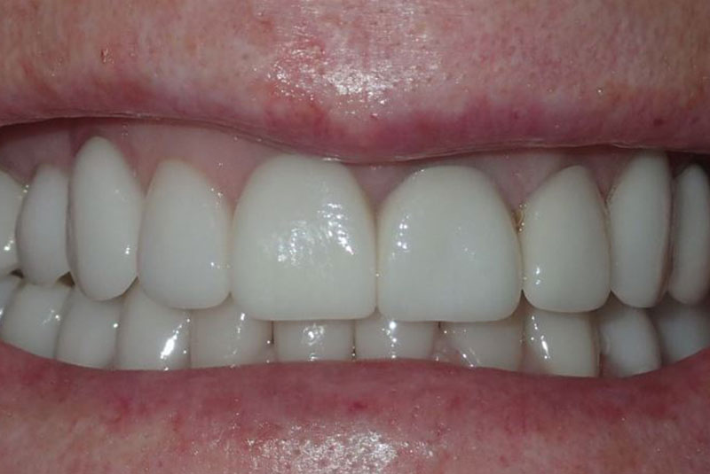 Close up of before and after dental procedure