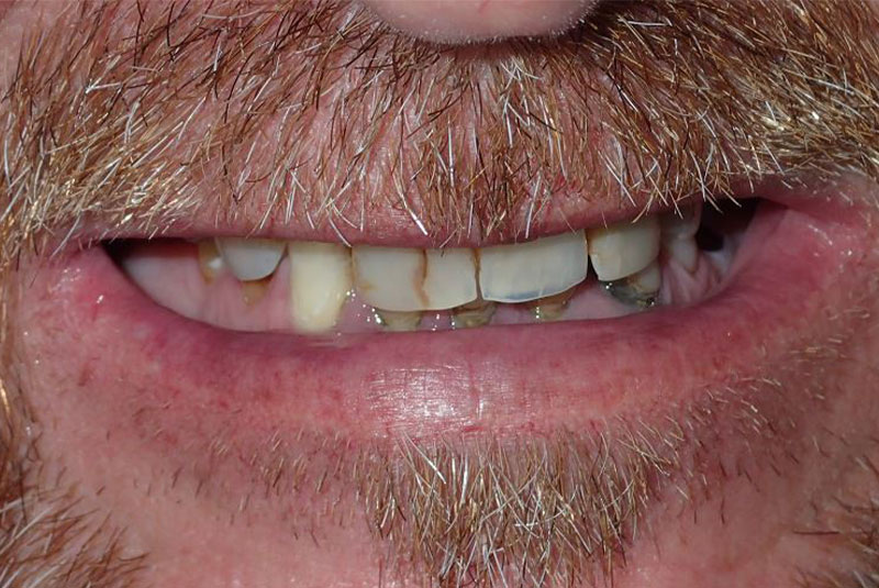 Close up of before and after dental procedure