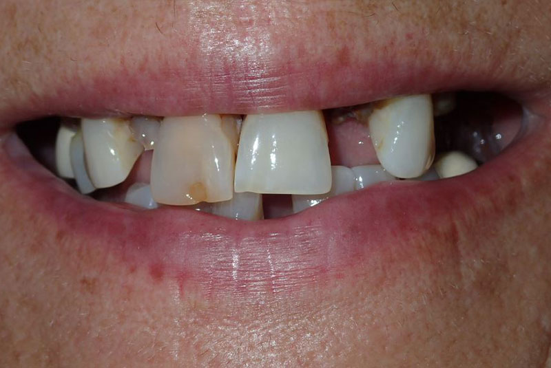 Close up of before and after dental procedure