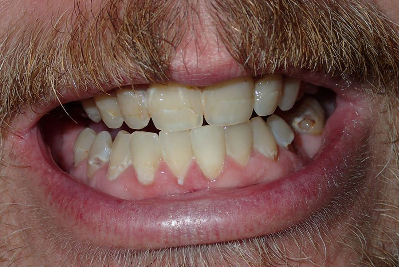 Close up of before and after dental procedure