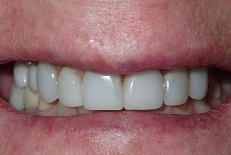 Close up of before and after dental procedure