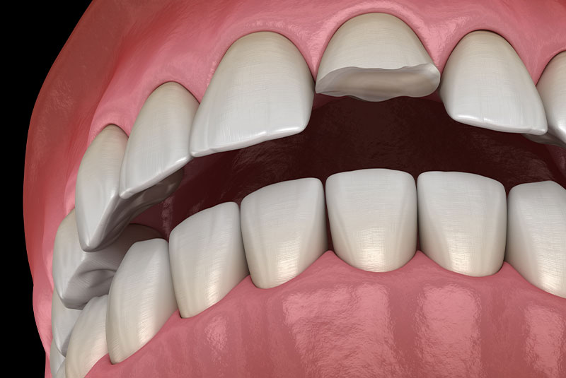Broken central incisor tooth. Medically accurate 3D illustration of human teeth and dentures concept