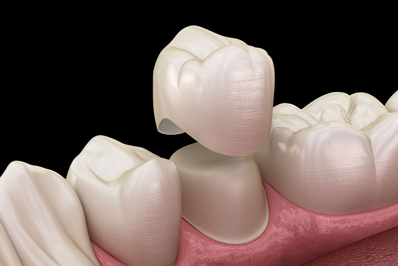 Dental crown premolar tooth assembly process. Medically accurate 3D illustration