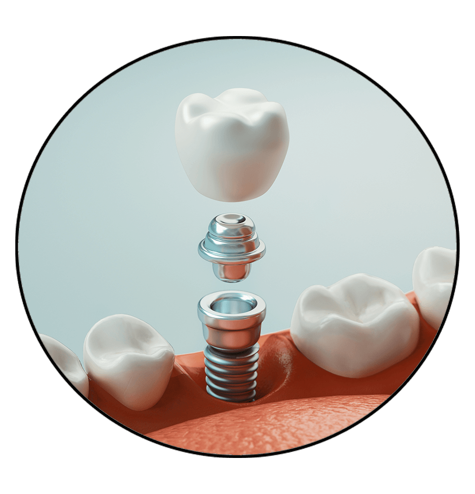 Dental implant circle frame