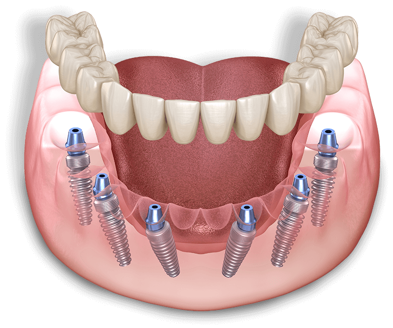 fulla arch dental illustration