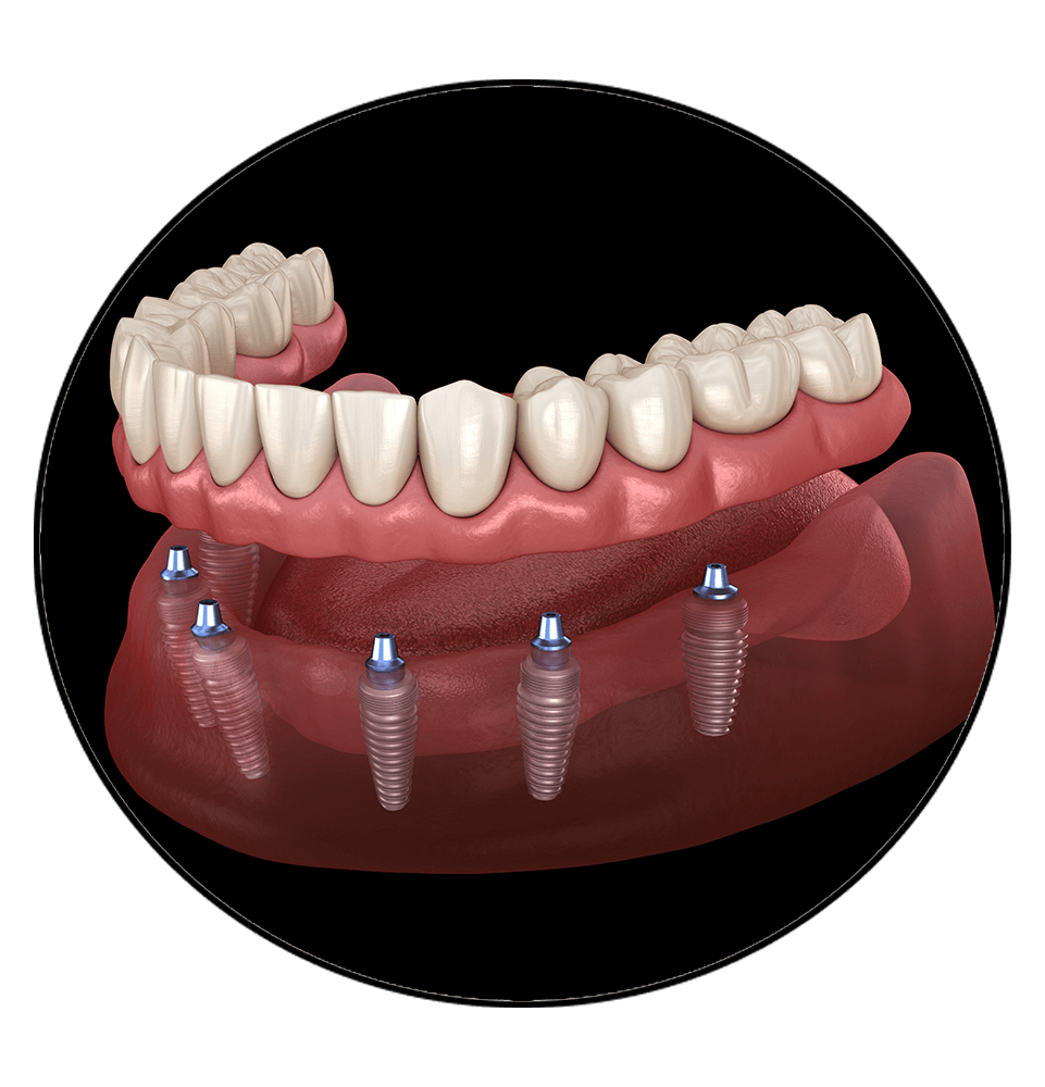 implant supporte dentures circle frame
