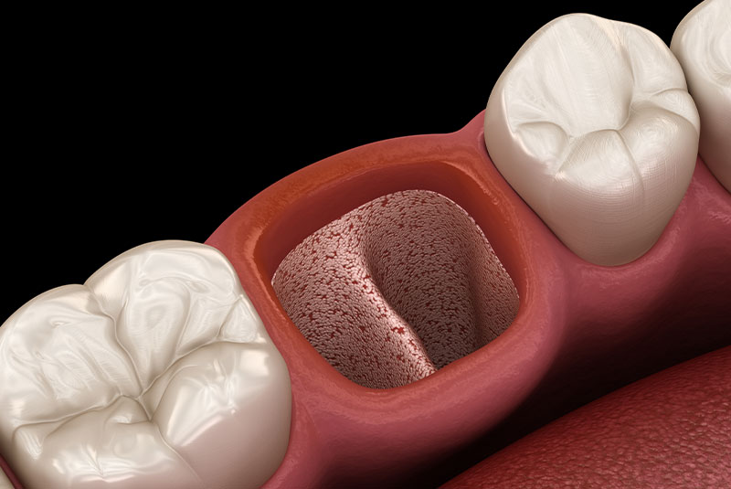 illustration of tooth extraction